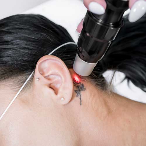 image of the Tattoo Removal treatment